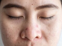 Sulit Tidur? Dermatologis Mengatakan Jerawat Anda Bisa Jadi Pelakunya
| beritakitanih Sulit Tidur? Dermatologis Mengatakan Jerawat Anda Bisa Jadi Pelakunya
| beritakitanih