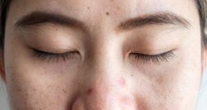 Sulit Tidur? Dermatologis Mengatakan Jerawat Anda Bisa Jadi Pelakunya
| beritakitanih Sulit Tidur? Dermatologis Mengatakan Jerawat Anda Bisa Jadi Pelakunya
| beritakitanih