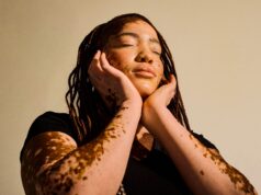 Vitiligo Lebih Mempengaruhi Daripada Kulit, Sebuah Survei Baru Menemukan
| beritakitanih Vitiligo Lebih Mempengaruhi Daripada Kulit, Sebuah Survei Baru Menemukan
| beritakitanih